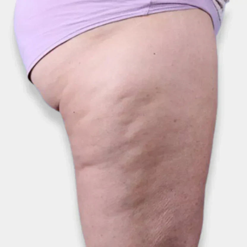 ¿Cómo combatir eficazmente la celulitis?